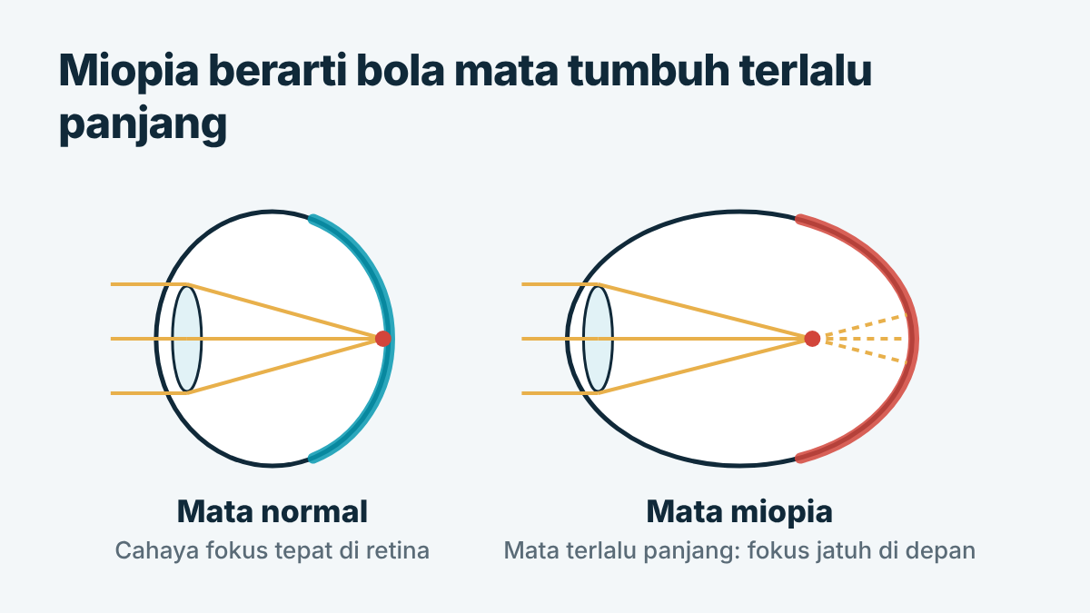 Diagram mata normal dibandingkan dengan bola mata miopia yang lebih panjang